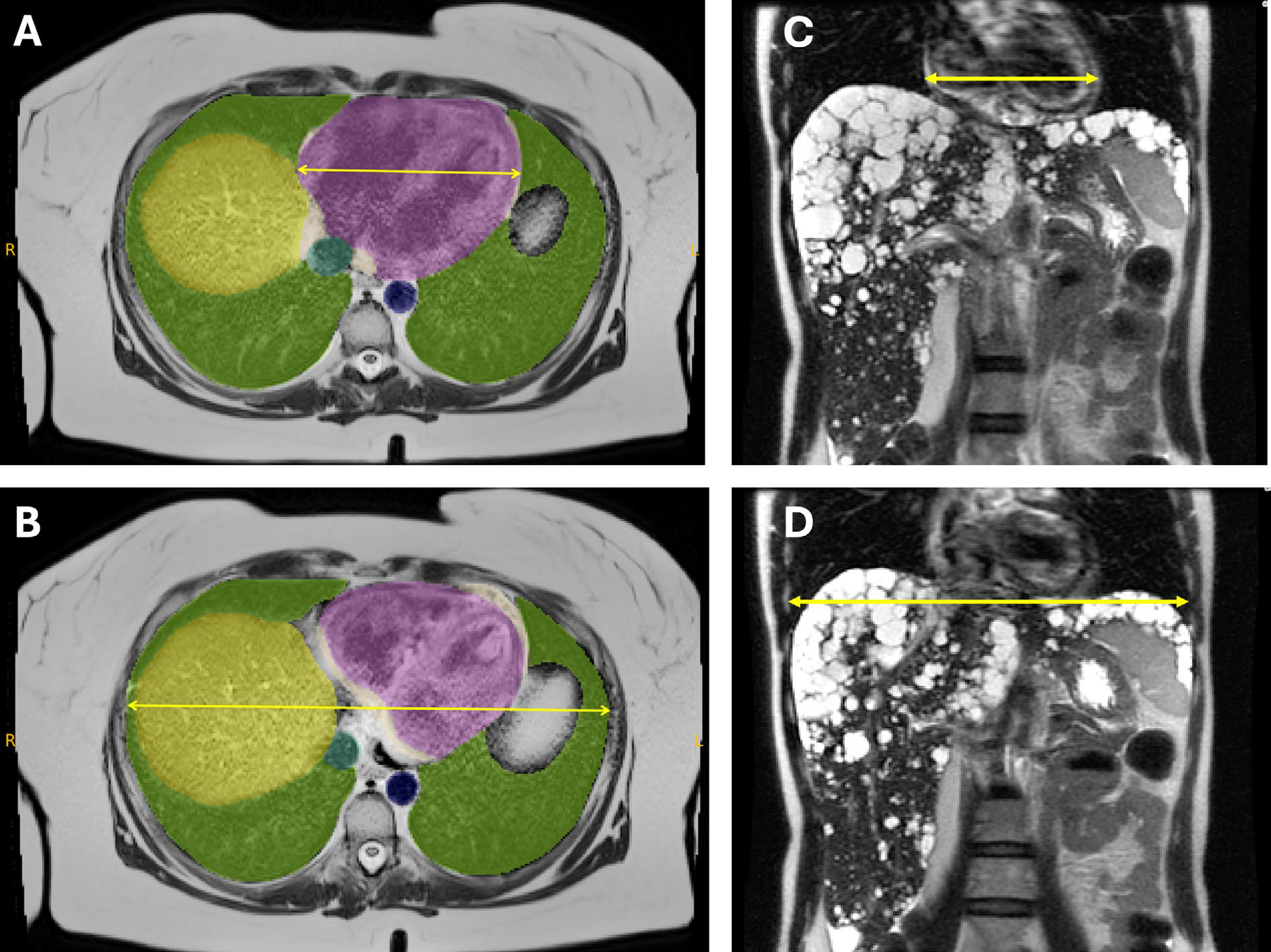 Figure 1 — CTR measured on abdominal MRI (Shen et al., JMRI 2026)